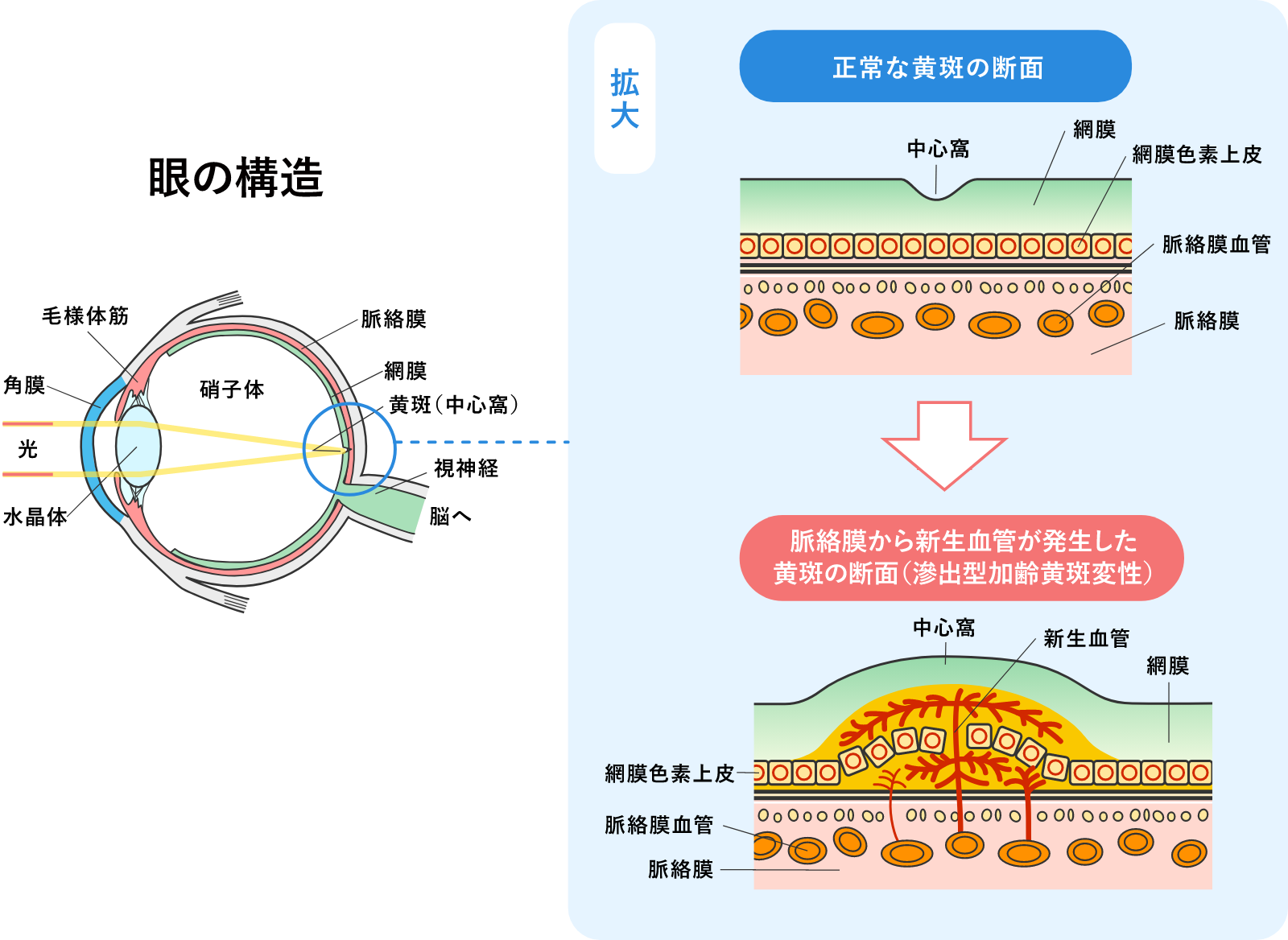 加齢黄斑変性１