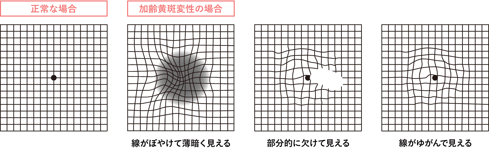 加齢黄斑変性２