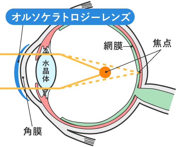 夜:レンズ装用中