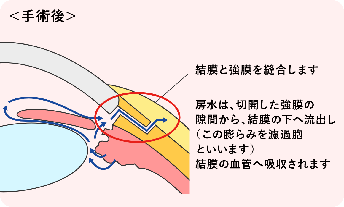 手術後